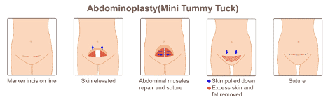 Tummy Tuck