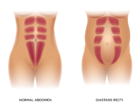 Diastasis Recti