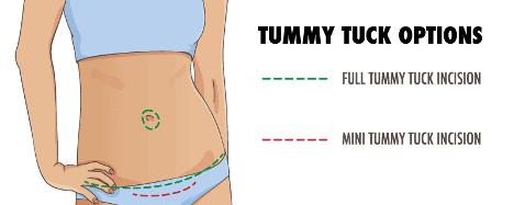 Tummy Tuck