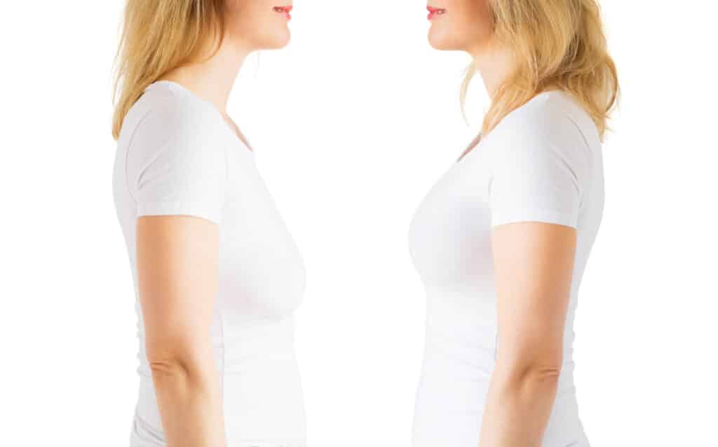 Breast Lift Before & After