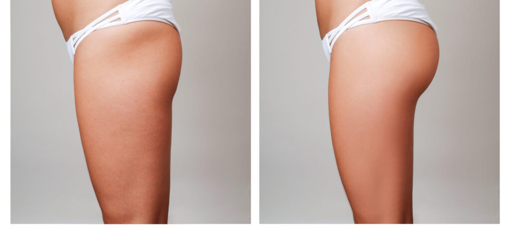 Buttocks Enhancement Through Fat Transfer Before & After