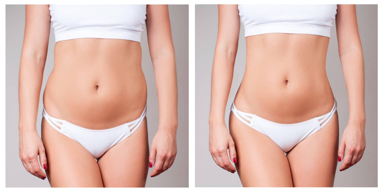 Seattle Liposuction Abdomen & Waist