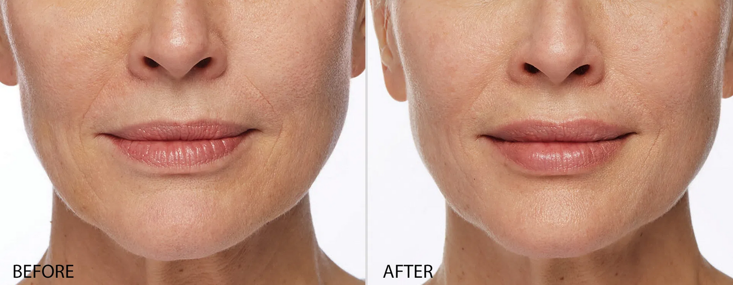 Restylane® Before & After