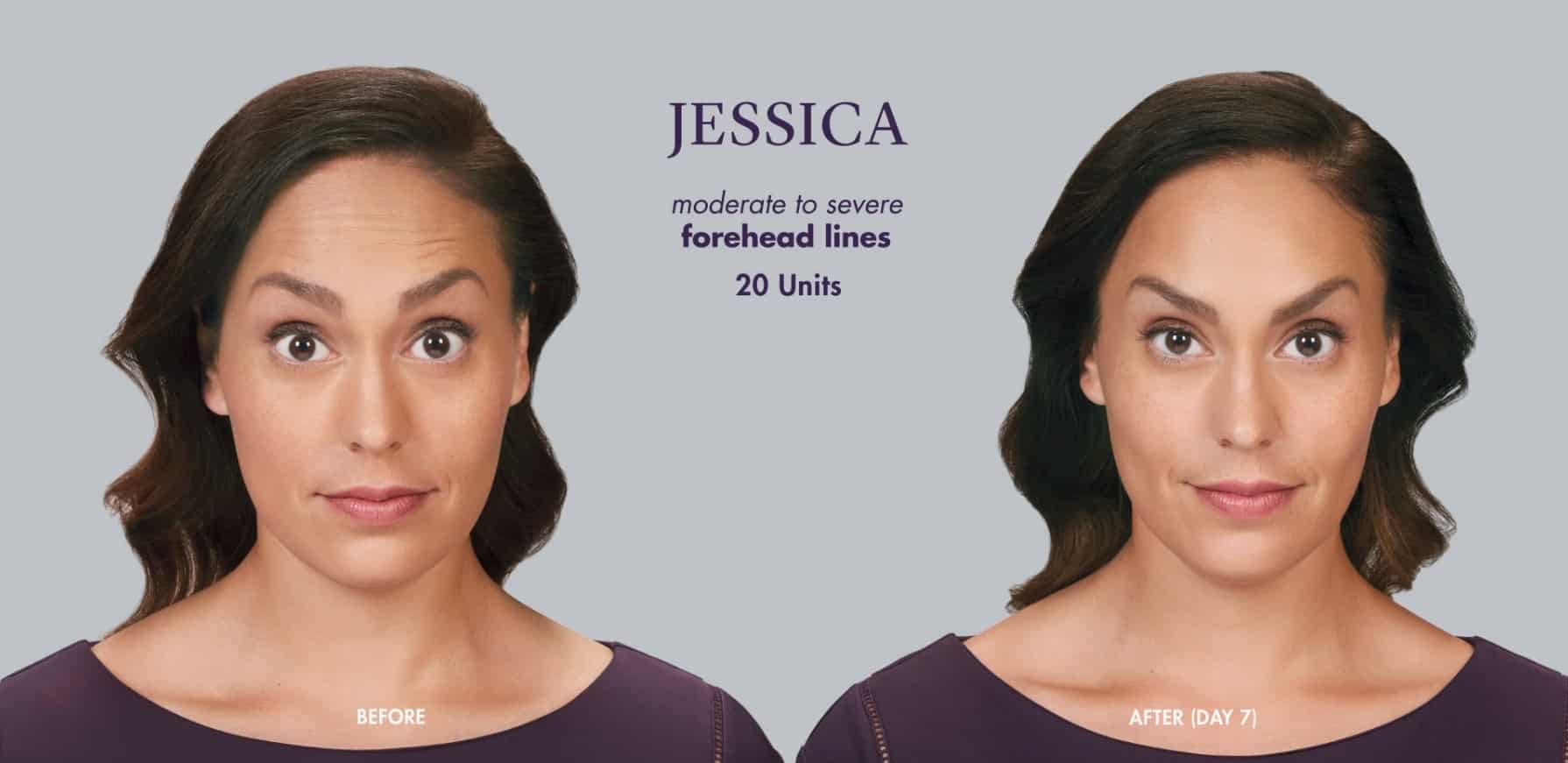 botox before & After