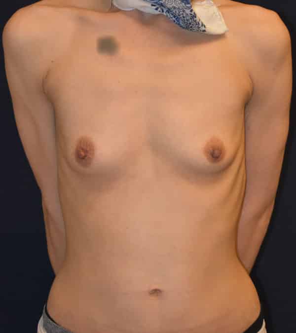 Breast Augmentation Results Seattle