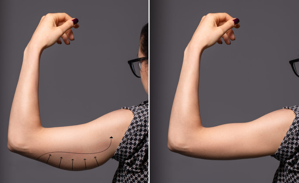 Arm Lift - Before & After - Dr. Won