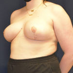Dr. Won - Breast Reduction