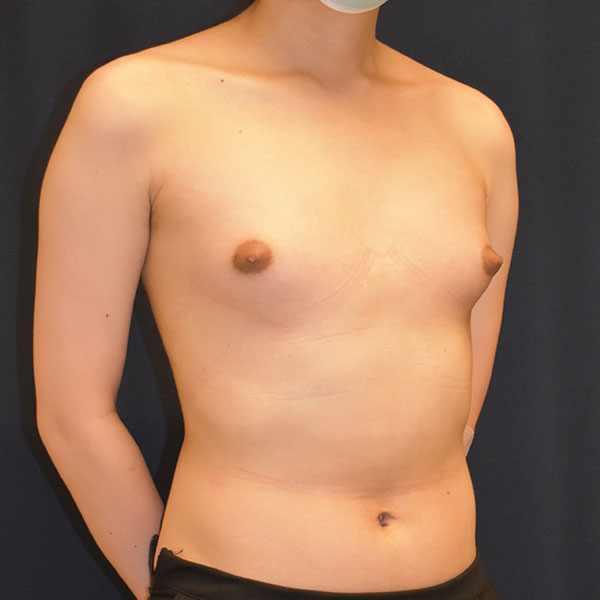 Dr. Won - Breast Augmentation
