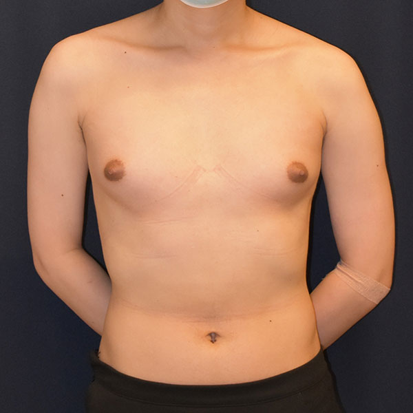 Transgender Surgery Male to Female Breast Augmentation Results Seattle
