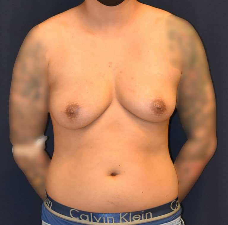 Transgender Surgery Female to Male Chest Reconstruction Results Seattle