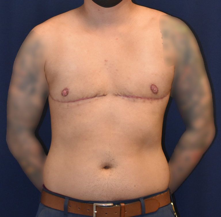 FTM Top Surgery Results Seattle