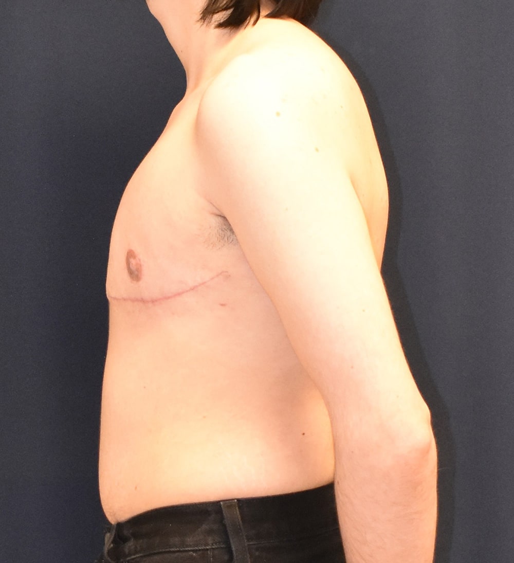 FTM Top Surgery Results