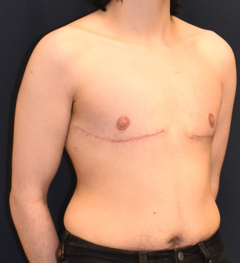 FTM Top Surgery Results