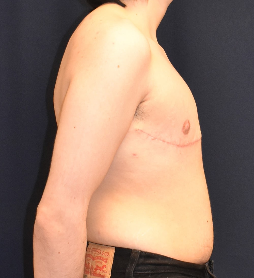 FTM Top Surgery Results