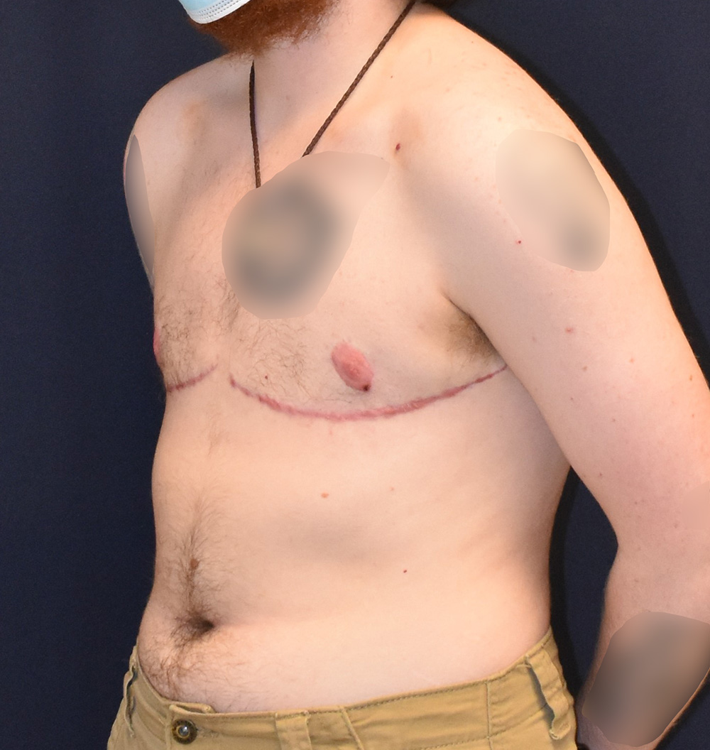 FTM Top Surgery Results
