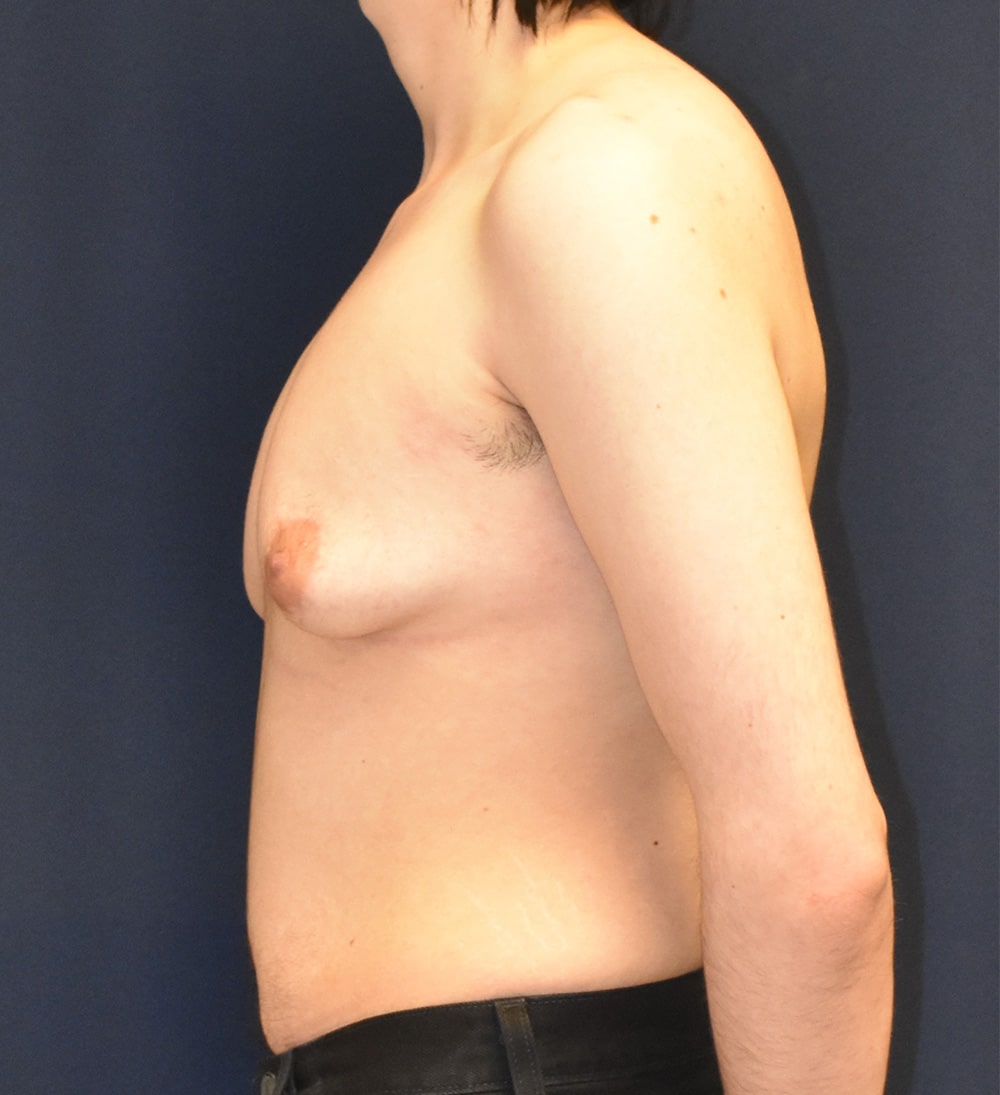 FTM Top Surgery Results