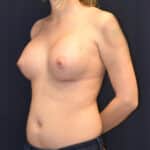 FTN Top Surgery Results