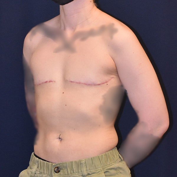 FTM Top Surgery Before & After Photos: #20704 | Dr. Won